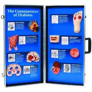 3B Scientific W43081 Consequences of High Blood Pressure 3D Display 